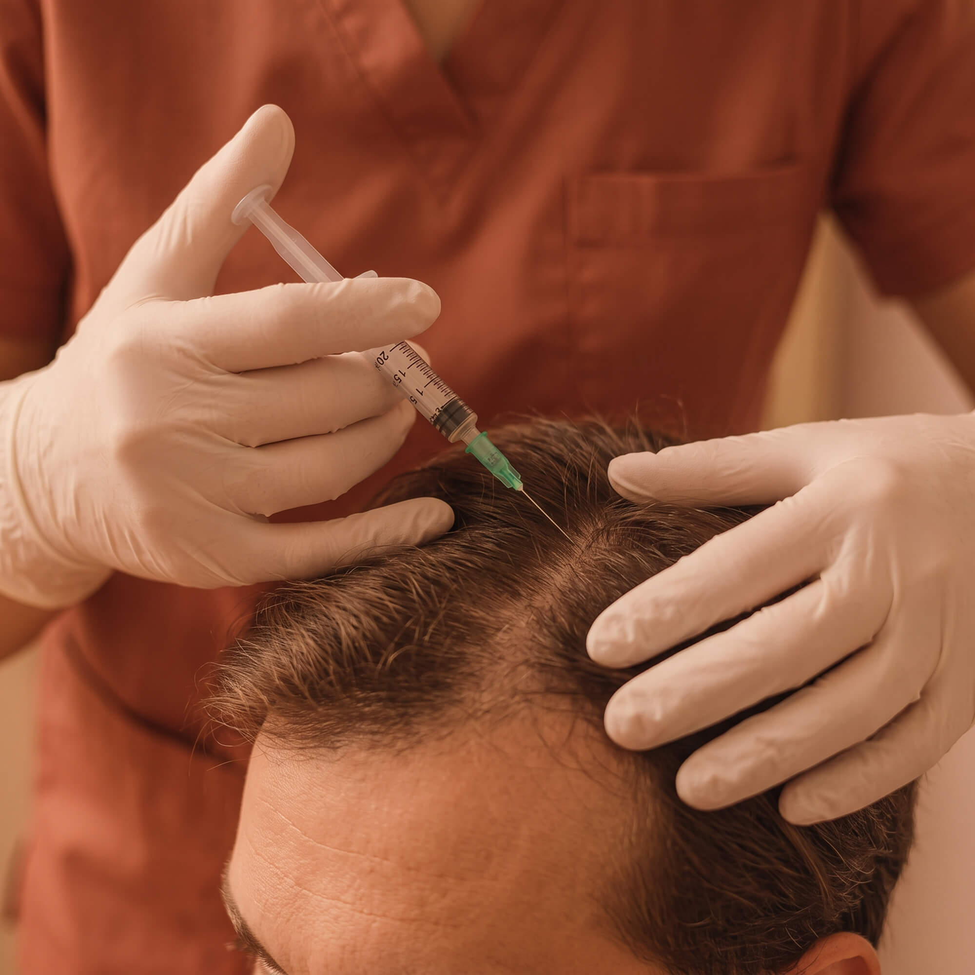 Hand mit medizinischem Handschuh injiziert mit einer Spritze in die Kopfhaut eines Mannes mit lichtem Haar